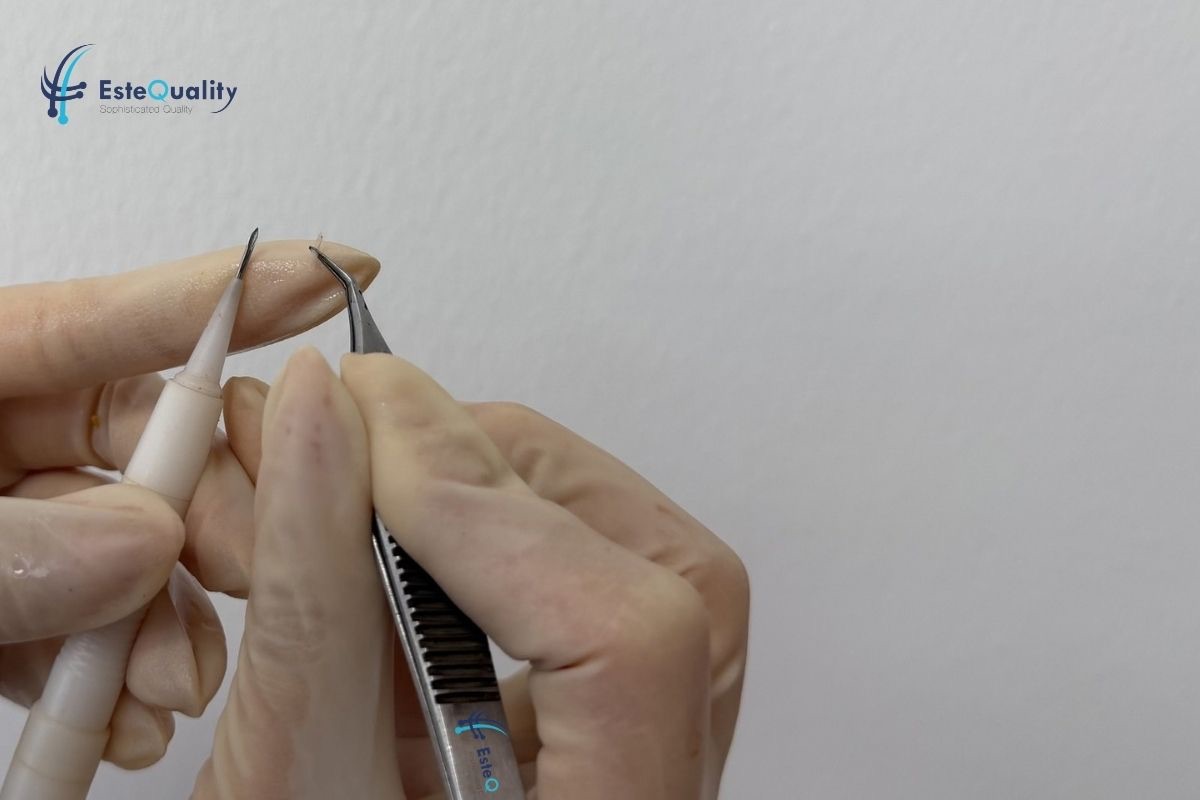 Graft being loaded into a DHI implanter pen with forceps