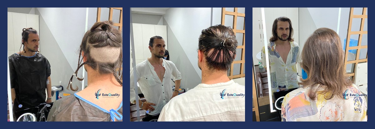 Donor area of an unshaven DHI patient with long hair. Left: before the procedure, narrow strips trimmed betwee