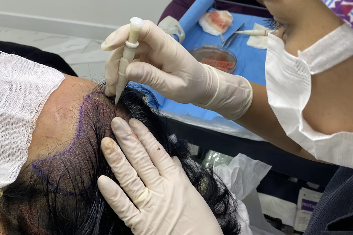 Unrasierte DHI bei einem Patienten mit langem Haar; das umliegende Haar bleibt erhalten und deckt den behandelten Bereich vom ersten Tag an ab