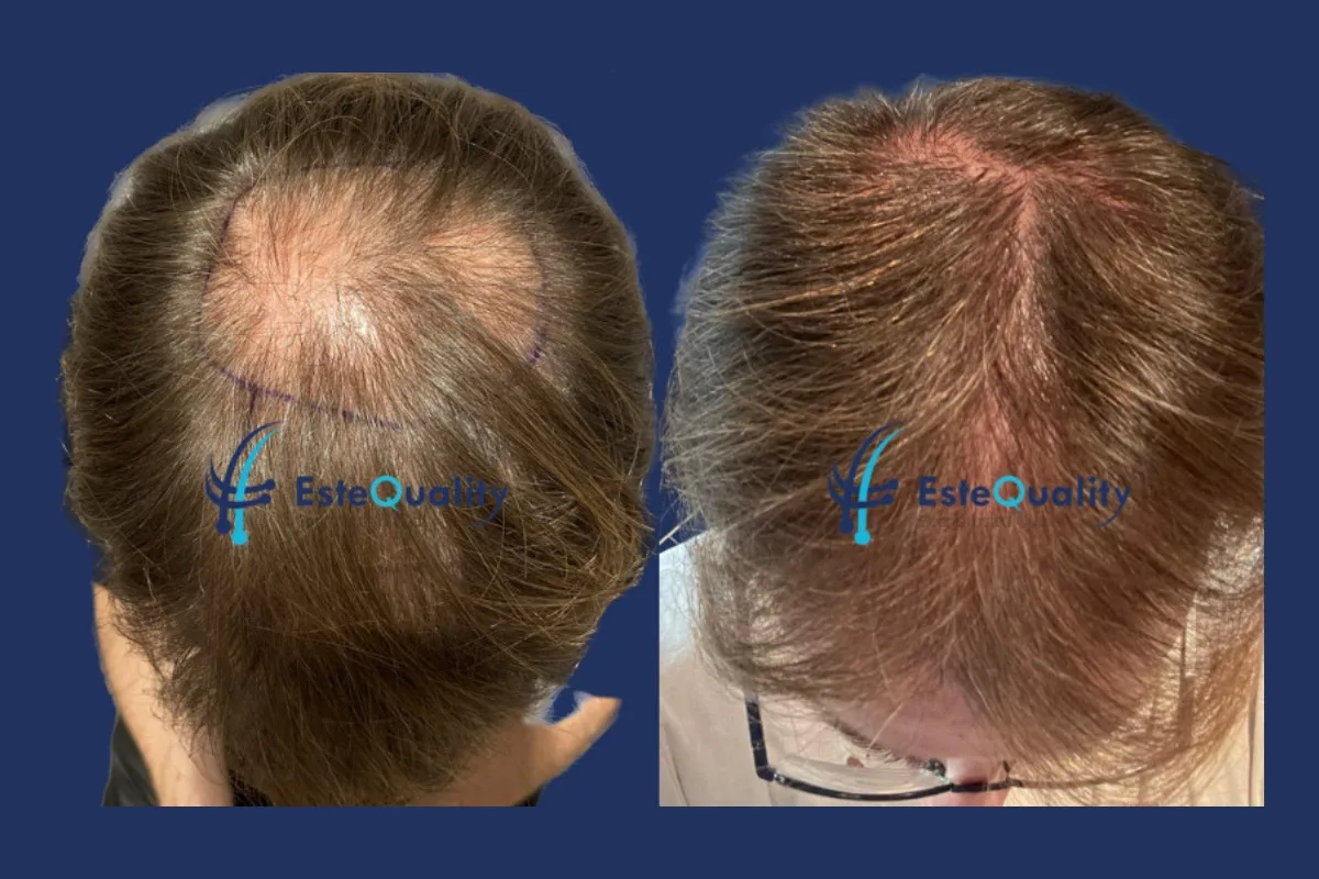 Patient in seinen 40ern. 2.500 Grafts, unrasierte DHI, Wirbelbereich. Ergebnis nach 11 Monaten; die Dichte im Wirbelbereich verbessert sich typischerweise weiter