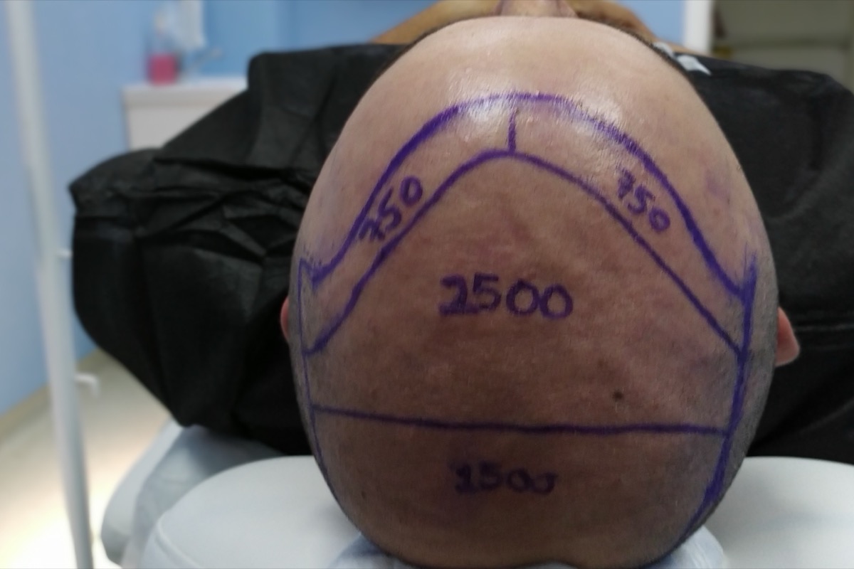 Scalp marked into zones with the planned number of grafts written on each zone