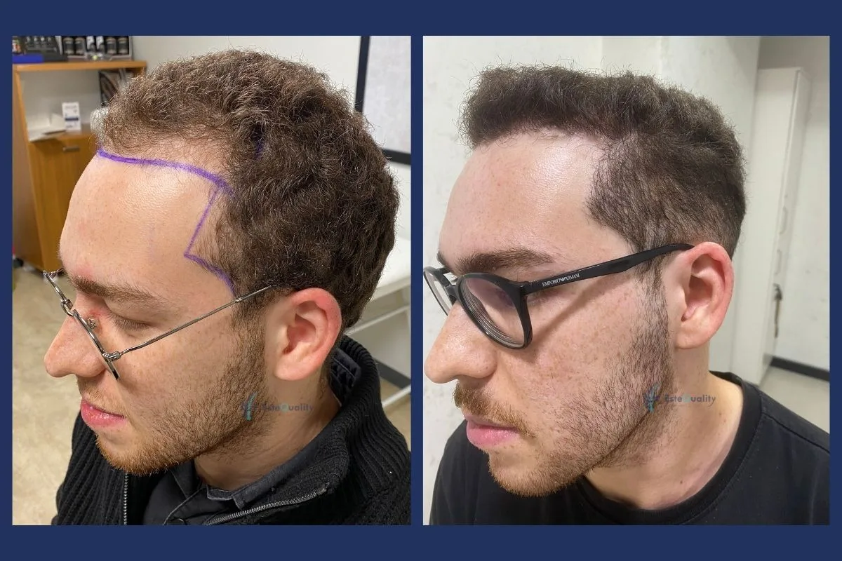 Patient in seinen 20ern. 4.000 Grafts, Sapphire FUE, mit natürlicher Wiederherstellung der Schläfen und Rekonstruktion des vorderen Haaransatzes. Erg