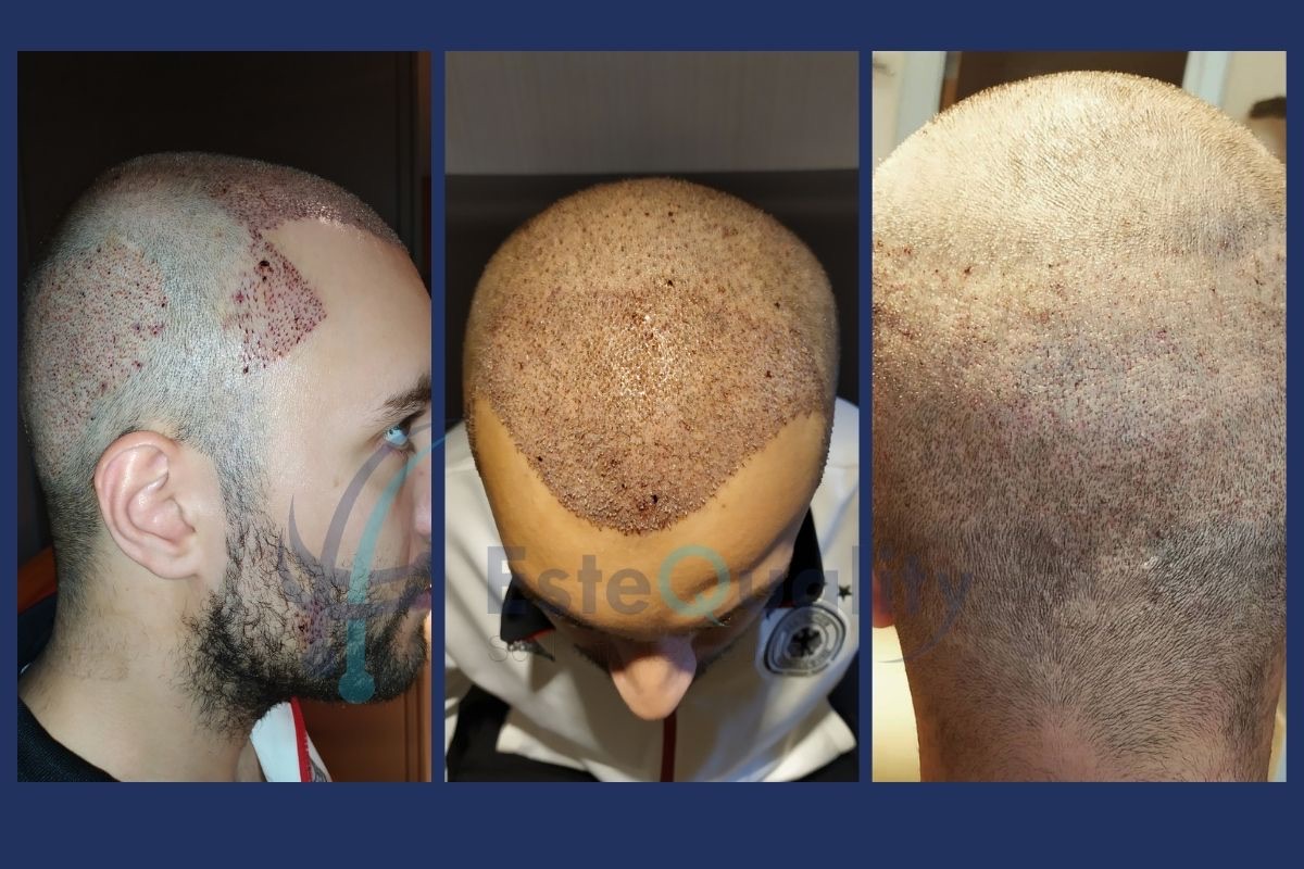Transplanted area after the first post-operative wash