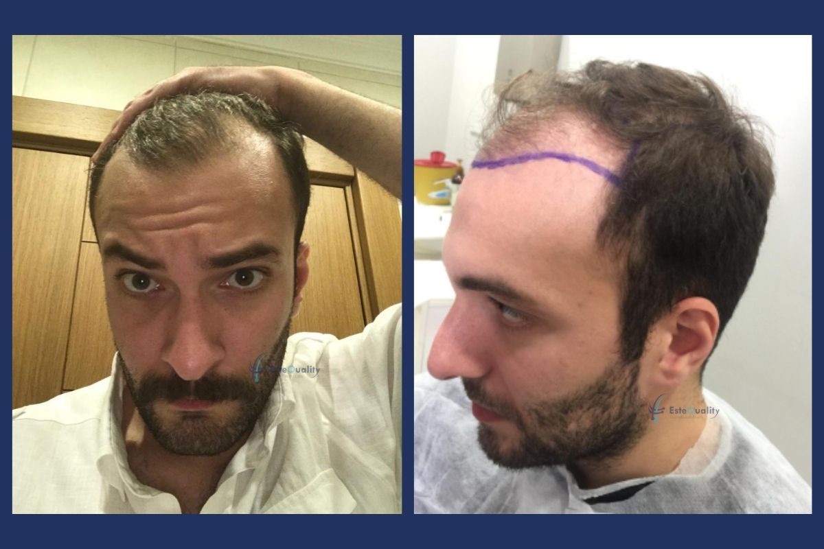 Recipient area before a Sapphire FUE hair transplant