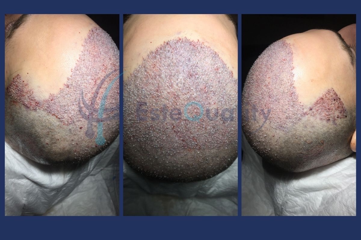 Recipient area immediately after Sapphire FUE hair transplant surgery