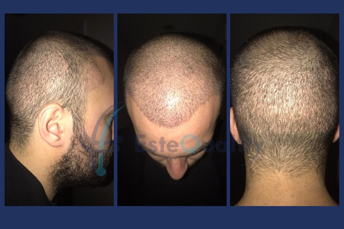 Recipient area 10 days after hair transplant surgery