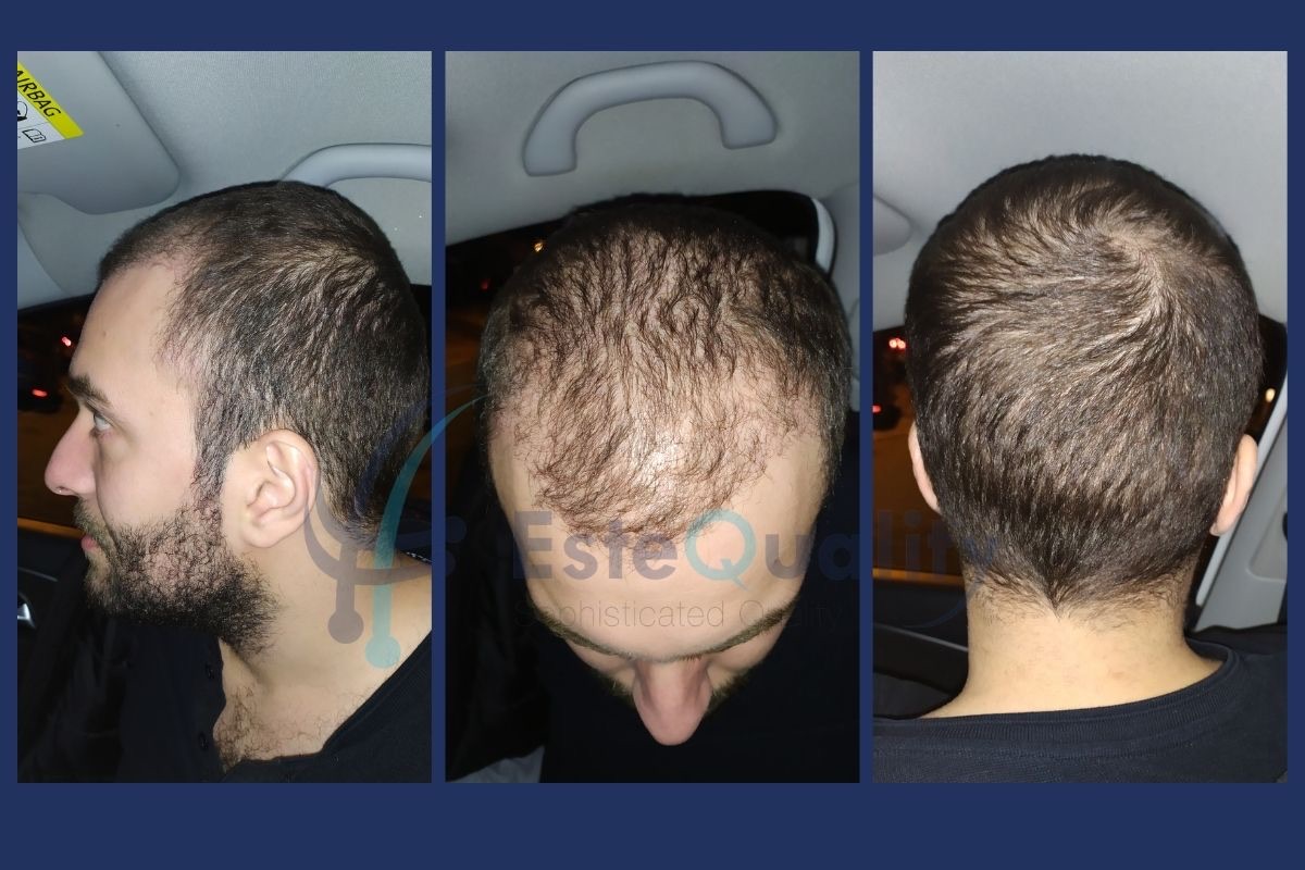Transplanted area one month after hair transplant surgery