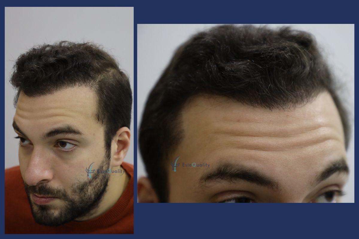 Hair transplant result at eleven months