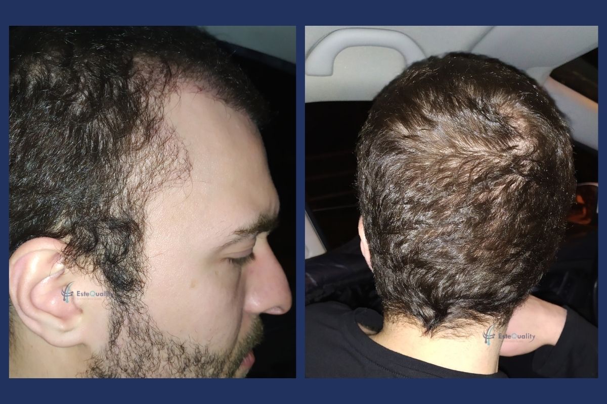 Hair growth three months after hair transplant surgery