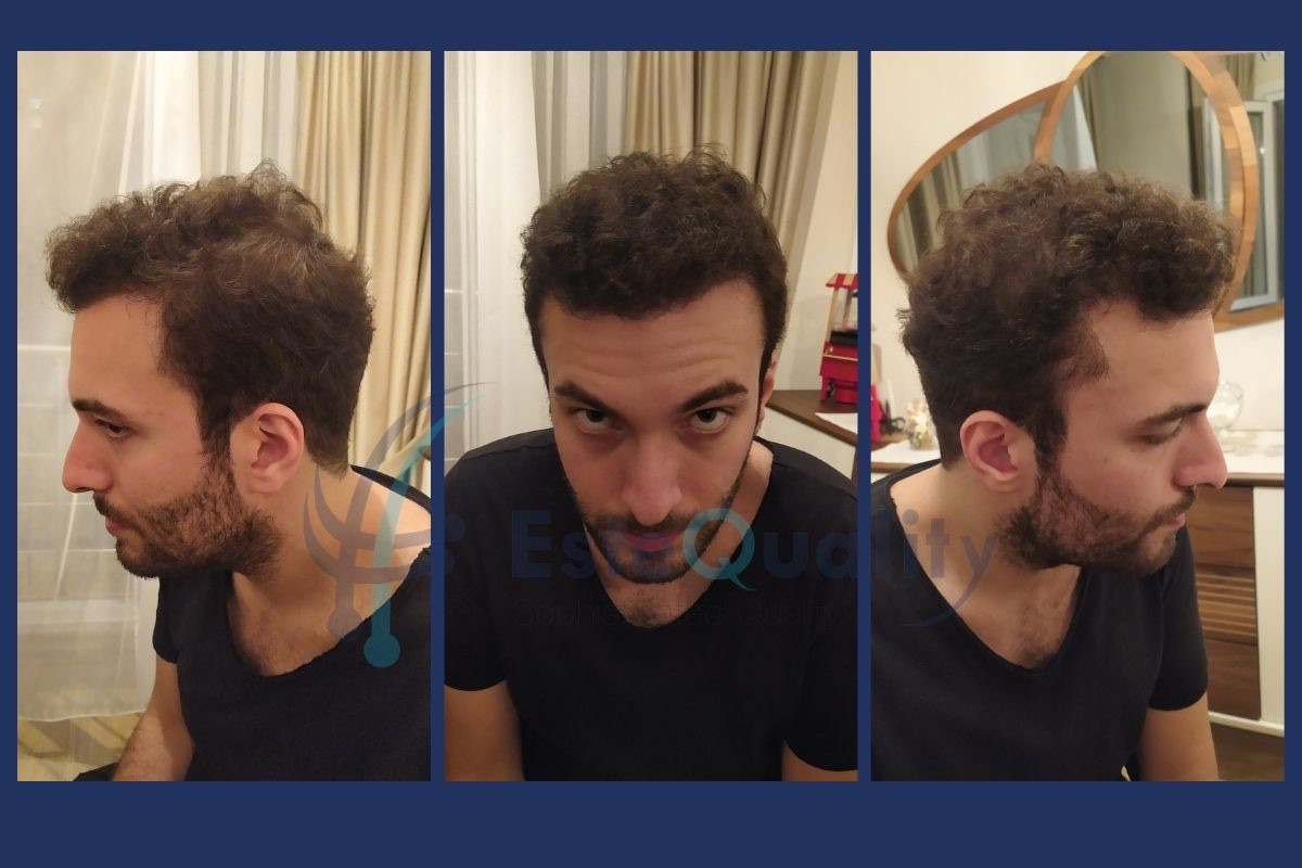Hair growth nine months after hair transplant surgery