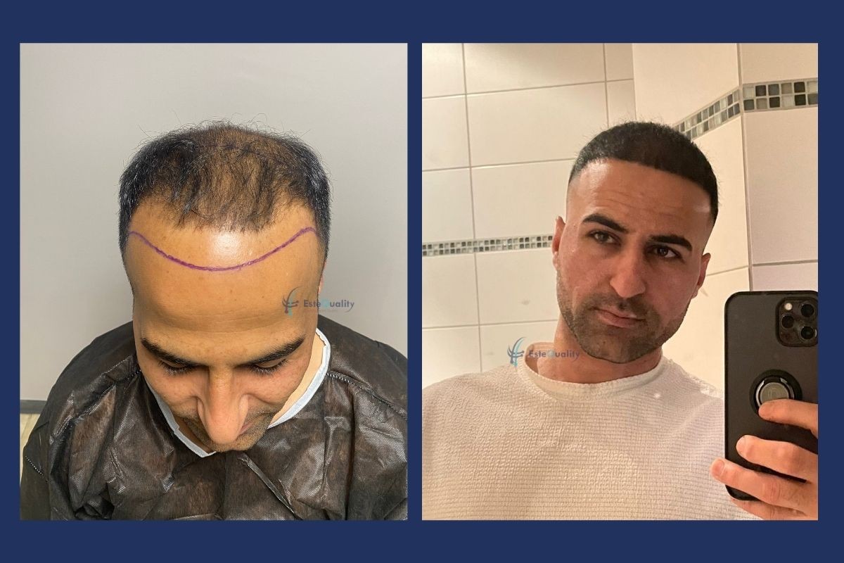 Advanced hair loss before and 9 months after a 5,500-graft Sapphire FUE hair transplant, worn as a buzz cut