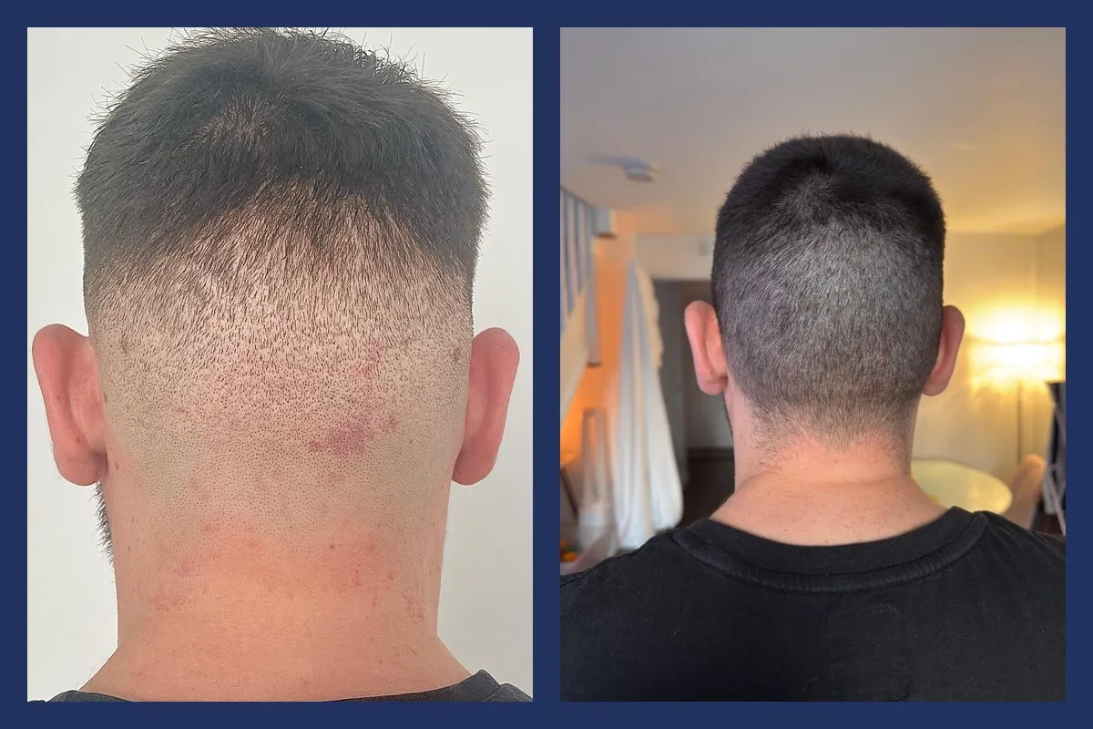 1.700 aus dem Bart entnommene Grafts, die mit DHI in den geschädigten Spenderbereich der Kopfhaut implantiert wurden. Ergebnis nach 12 Monaten. Das Vorher-Foto