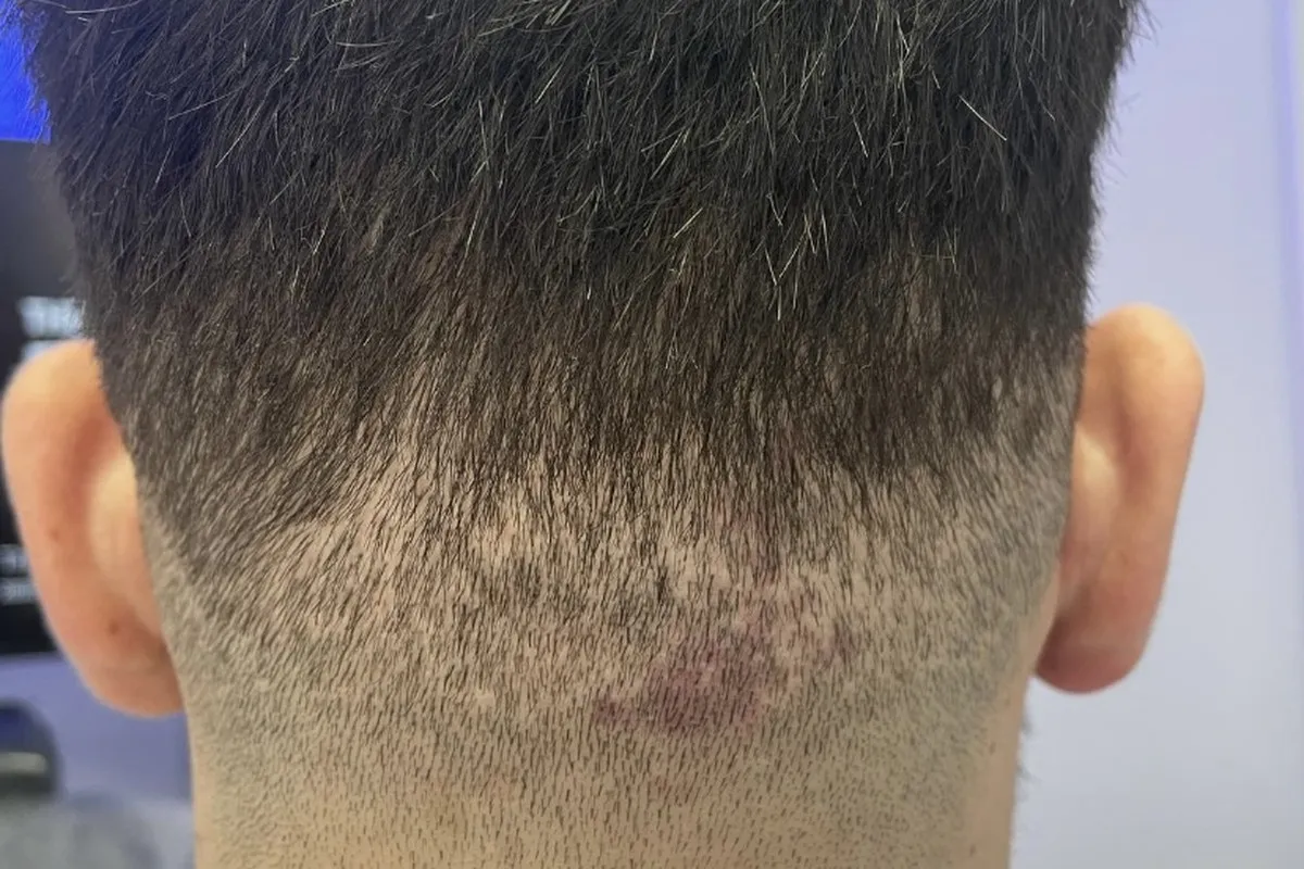 So sah der Entnahmebereich bei der Ankunft aus: sichtbare Narben und Ausdünnung, nachdem andernorts 4.500 Grafts entnommen worden waren.