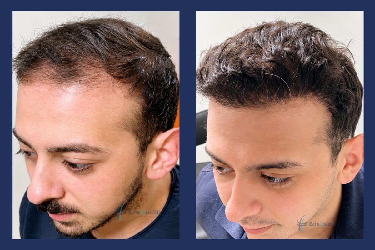 Hairline before and 9 months after a 5,300-graft Sapphire FUE hair transplant, side view