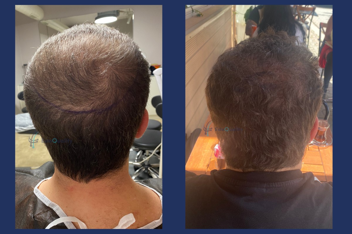 Back before and 12 months after a 7,000-graft Sapphire FUE hair transplant
