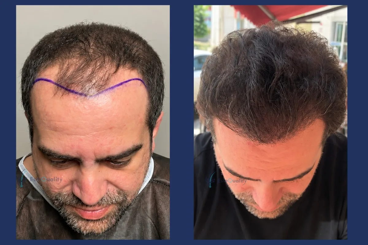 Patient in seinen 30ern. 7.000 Grafts in einer Sitzung, Sapphire FUE, rasiert. Ergebnis nach 12 Monaten. Eine so hohe Graft-Anzahl