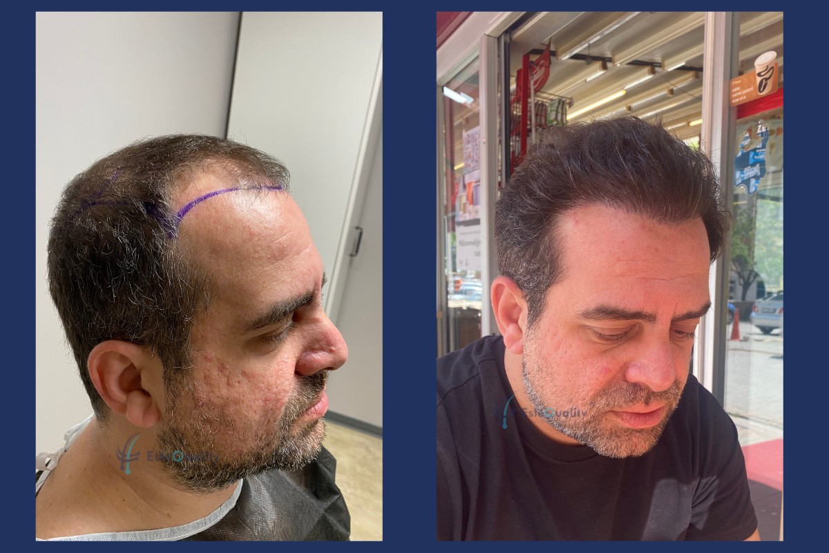 Left side before and 12 months after a 7,000-graft Sapphire FUE hair transplant