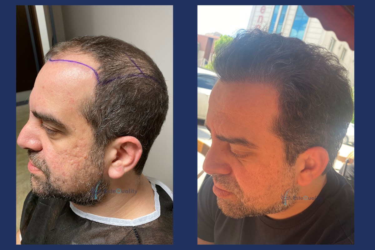 Right side before and 12 months after a 7,000-graft Sapphire FUE hair transplant