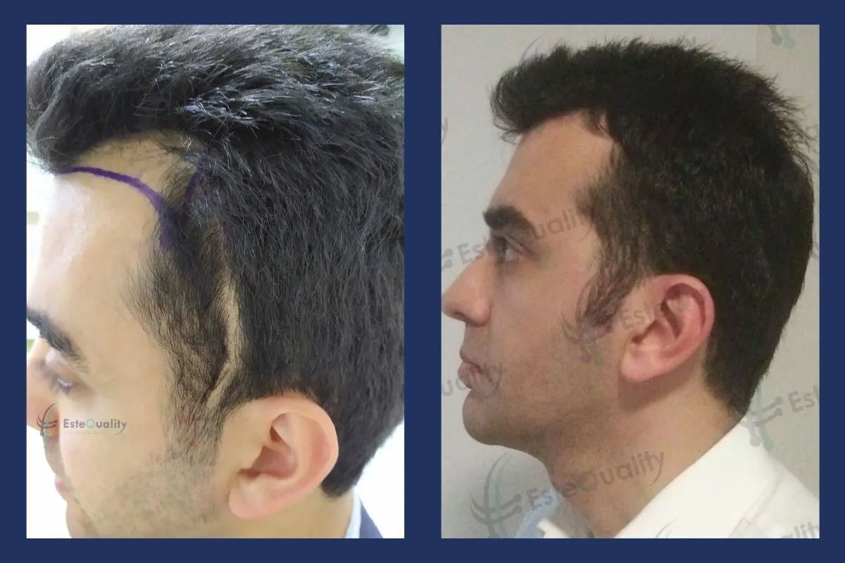 1.900 Grafts, unrasierte DHI, nach 8 Monaten. In diesem Fall wurde eine alte Operationsnarbe am Hinterkopf abgedeckt und der Haaransatz in derselben Sitzung wiederhergestellt