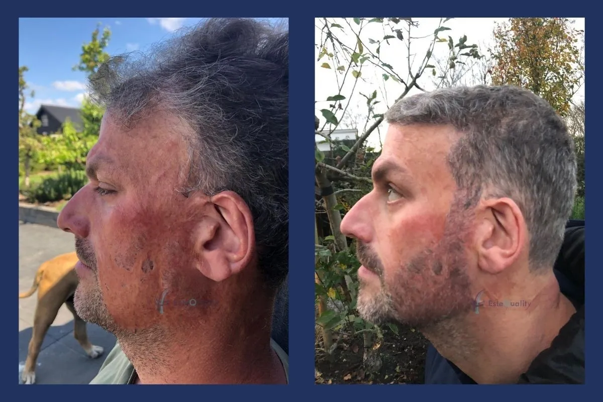 5.500 Grafts, FUE, Haar und Bart in einem Plan. Narbengewebe durch Verbrennungen ist schlechter durchblutet, daher ist das Anwachsen der Grafts geringer