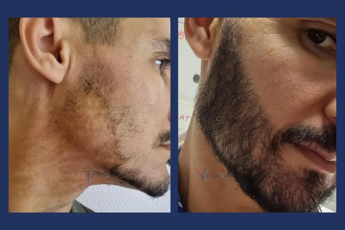 4.500 Grafts, Sapphire FUE, in reifes Verbrennungsnarbengewebe an Wange und Kieferlinie eingesetzt. Das Nachher-Foto zeigt dieselbe Seite aus einem näheren Bildausschnitt