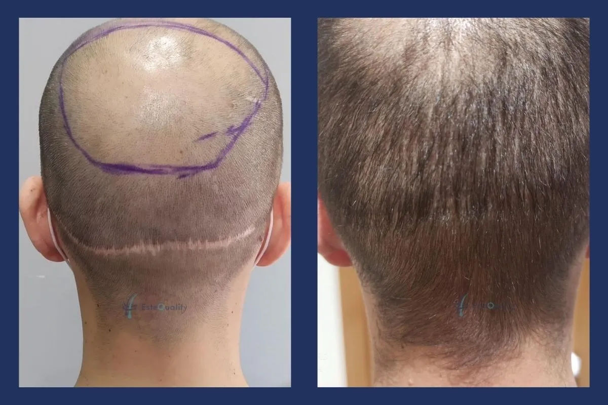 Gleiche Sitzung, insgesamt 3,950 Grafts: Der Frontbereich hatte Priorität, 400 Grafts wurden in die alte FUT-Streifennarbe eingesetzt