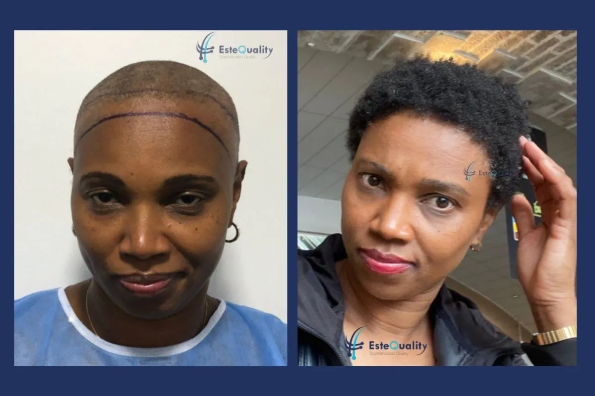 4.500 Grafts, Sapphire FUE, rasierter Eingriff, wobei die meisten Grafts am Haaransatz platziert und die übrigen über den Oberkopf verteilt wurden