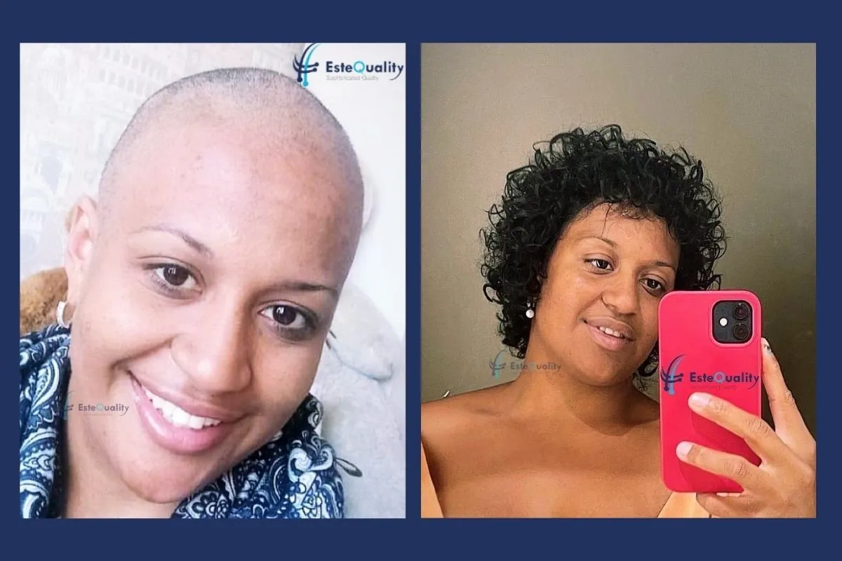 5.200 Grafts, Sapphire FUE, rasierter Eingriff. Diffuser, männlichem Muster entsprechender Haarausfall bei einer Frau in ihren 50ern; deshalb trug sie ihr