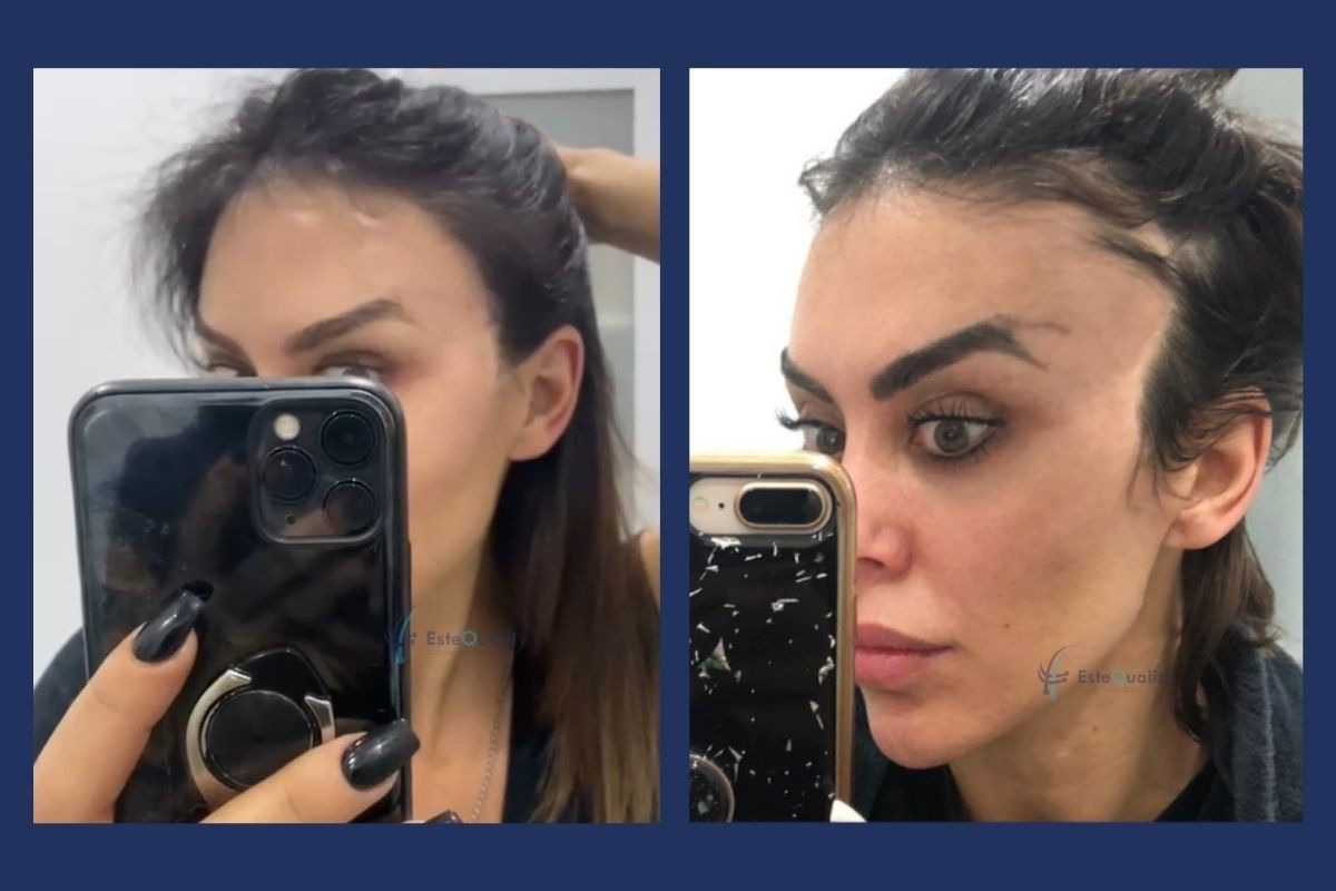 2,300 grafts, unshaven DHI. Facelift incisions can shift or thin the temple and sideburn hairline; here the ha