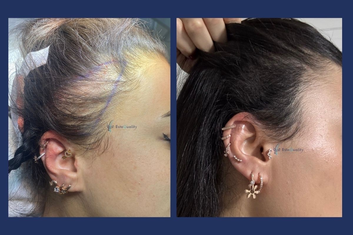 2,500 grafts, unshaven DHI. Years of tight ponytails, buns or a firmly tied headscarf can pull the hairline ba