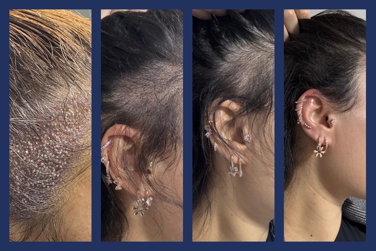 The same temple over six months. Day of the procedure, with the grafts placed between the existing hair; day 1