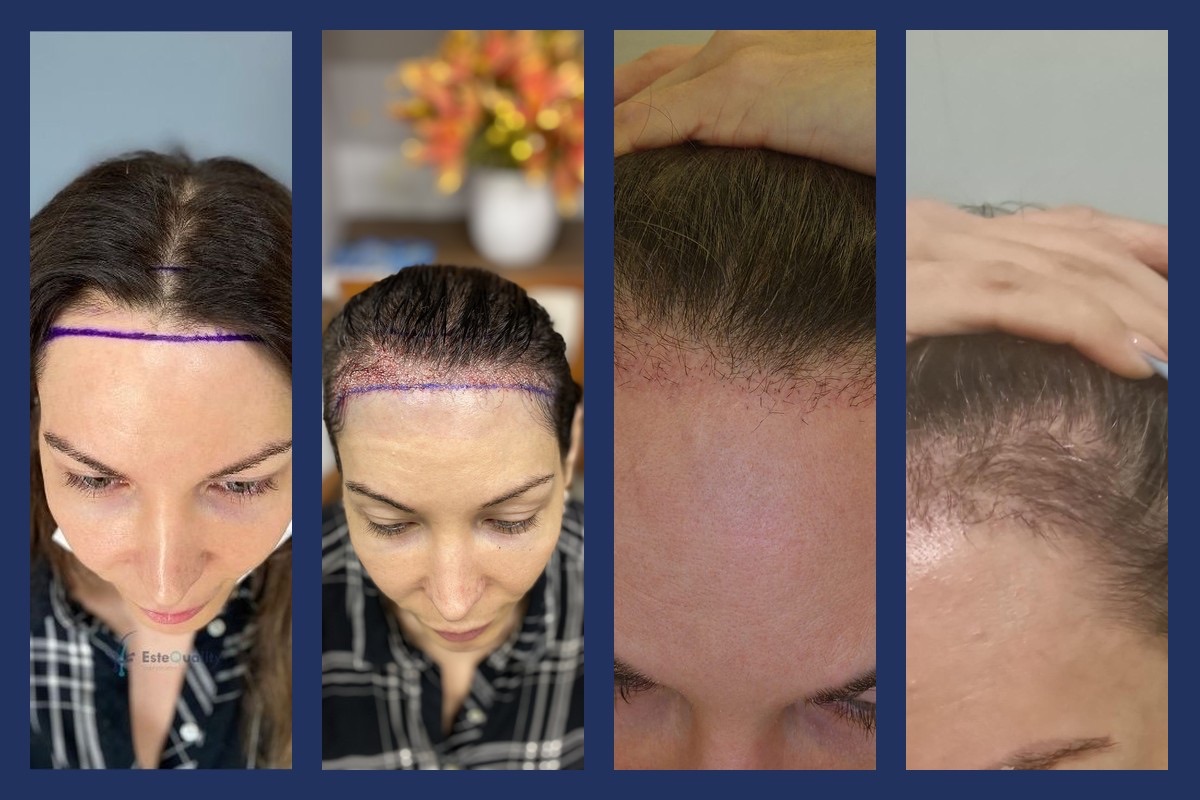What the first months look like with unshaven DHI at the hairline. Left to right: the planned line; the day of