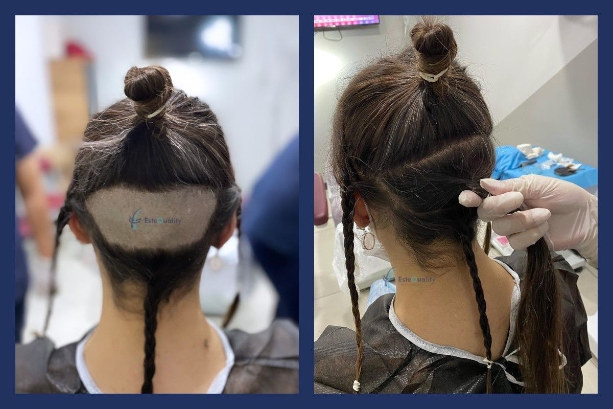 What unshaven means for the donor area: only a small patch at the nape is shaved, under the top layer of hai