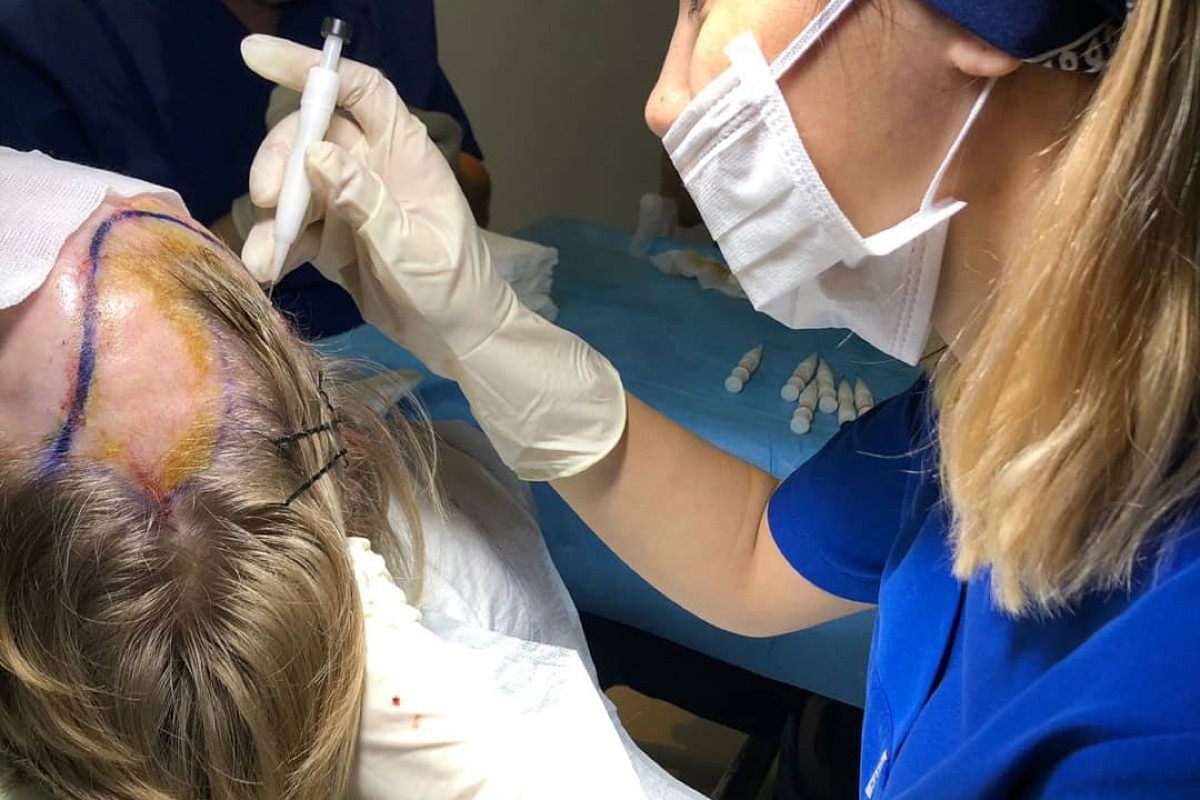Unshaven DHI on a female patient: the recipient area is not shaved, so the existing hair covers the treated zo